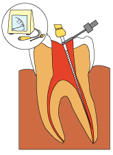 歯の根の長さを測る
