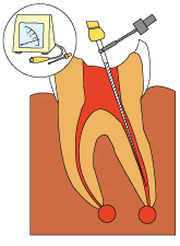歯の根の長さを測る