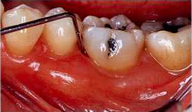 歯周組織(歯周精密)検査